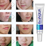 Cream Treatment Blackhead Remove Anti Acne - Simooe 