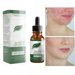Treating acne and pimples - Simooe 
